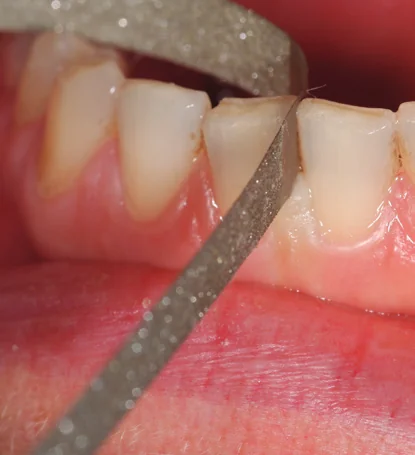 COMPO-STRIP en situation clinique
