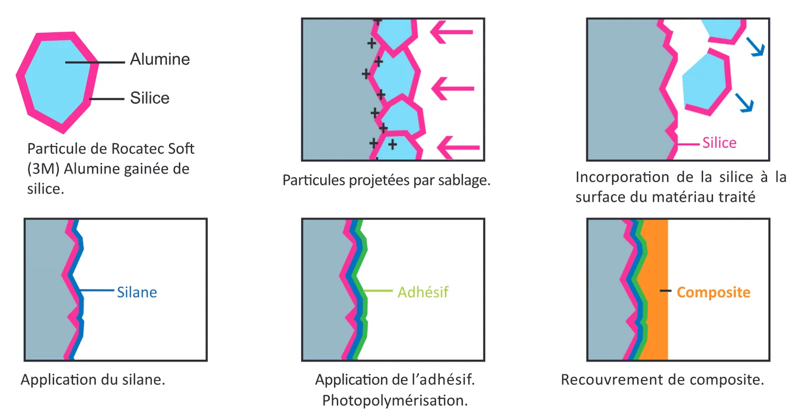 Particule de Rocatec™ Soft, projection, incorporation de la silice, silane, adhésif, composite