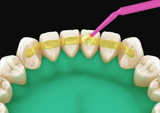Étape 6